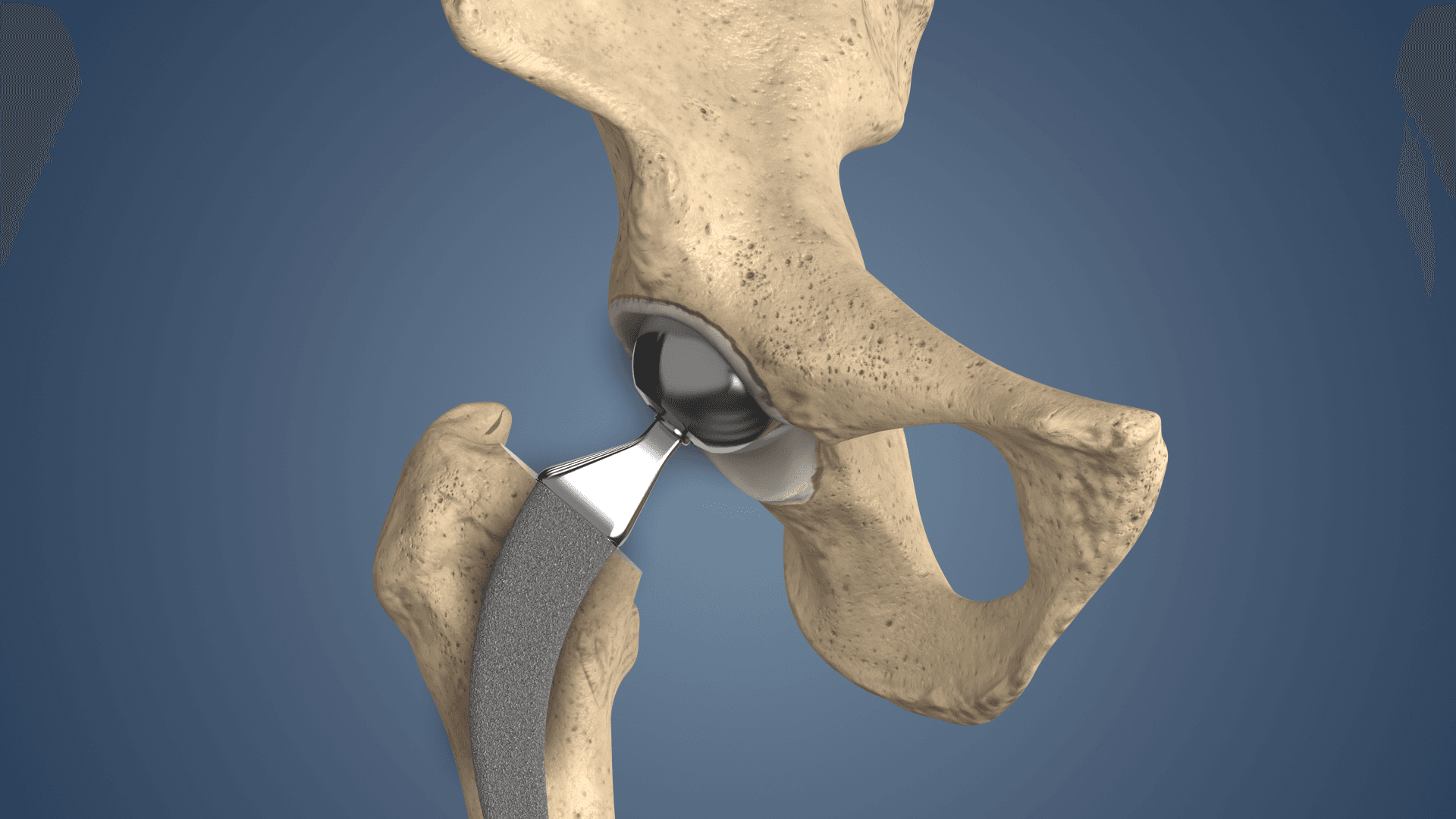 Hip Replacement Video Guide