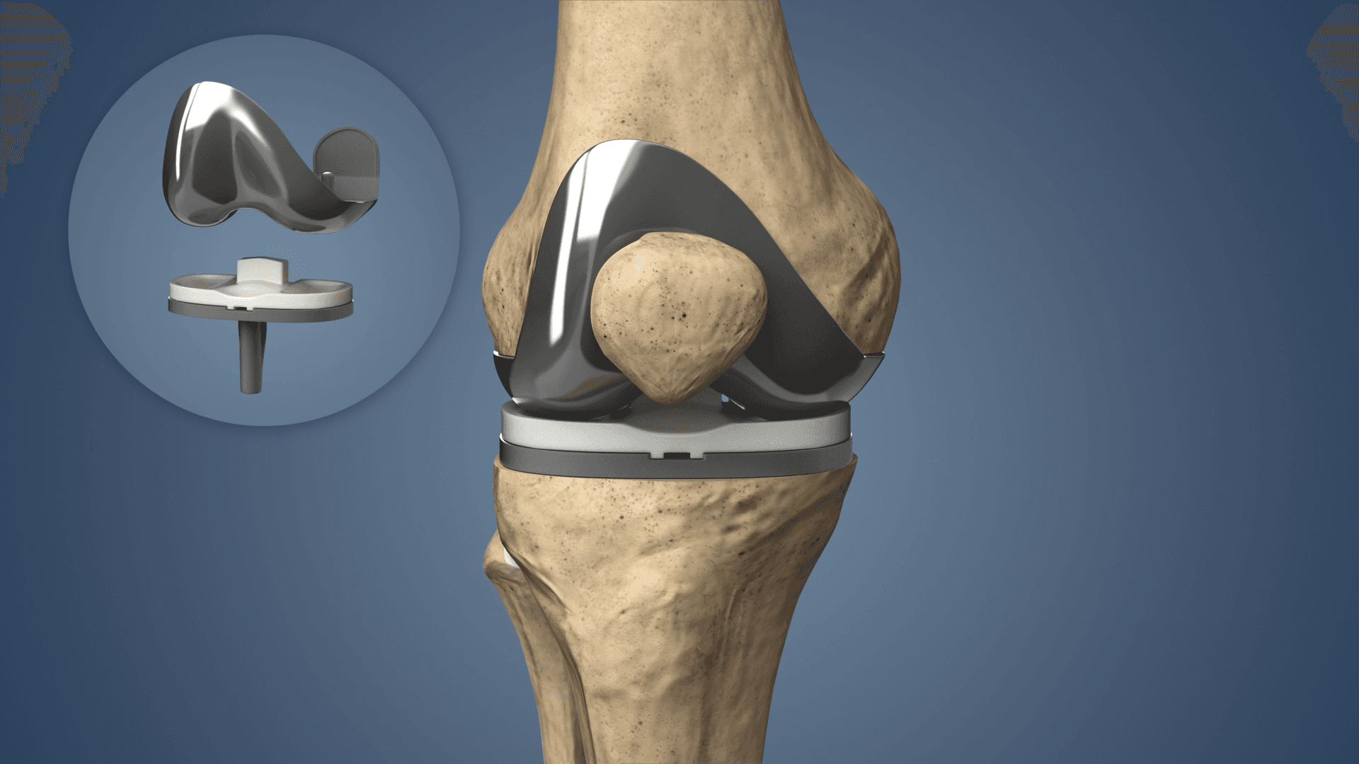 Knee Replacement Video Guide